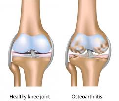 Osteoartritis - degenerativna bolest zglobova