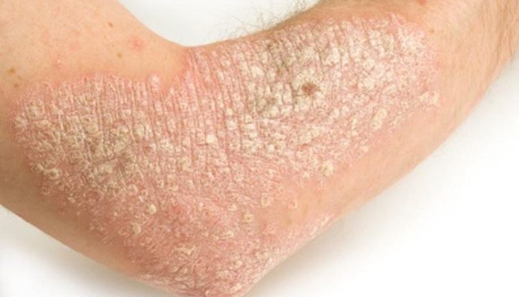 Aloe Vera pomaže kod psorijaze